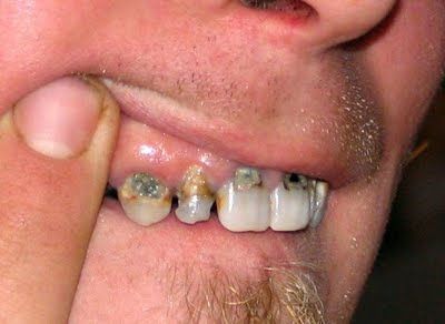 Name:  gross_teeth_005.jpg
Views: 7949
Size:  19.7 KB