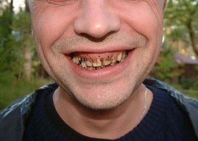 Name:  gross_teeth_014.jpg
Views: 9986
Size:  21.8 KB