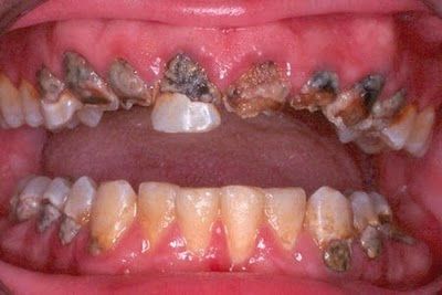 Name:  gross_teeth_016.jpg
Views: 5159
Size:  21.3 KB