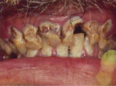 Name:  gross_teeth_032.jpg
Views: 3745
Size:  27.6 KB