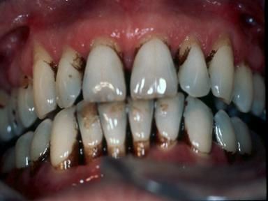 Name:  gross_teeth_038.jpg
Views: 5061
Size:  17.7 KB