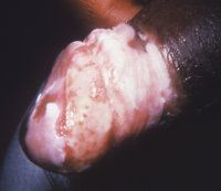 Name:  Balanitis_gangraenosa1.jpg
Views: 254
Size:  5.7 KB