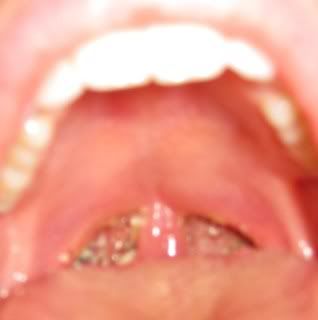 Name:  Tonsils007.jpg
Views: 890
Size:  13.5 KB