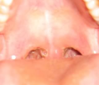 Name:  Tonsils008.jpg
Views: 704
Size:  12.4 KB