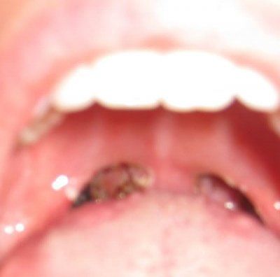 tonsils_removed_gross_001.jpg