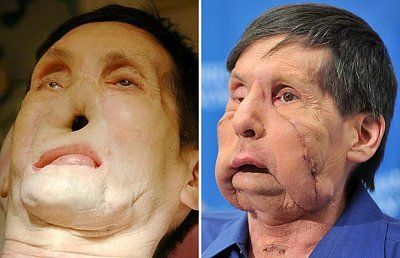 face-transplant_1408434i.jpg