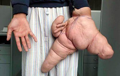 largest-hand-surgery.jpg