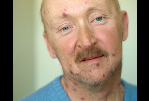 corbis_rm_photo_of_man_with_aids_ks.jpg