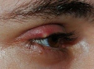 Name:  stye-300x220.jpg
Views: 342
Size:  20.3 KB