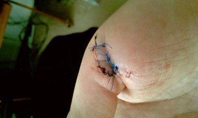 stitches-1-2.jpg