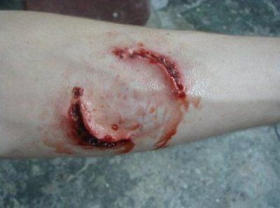 bitten_homeless.jpg