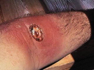 Name:  img_brown_recluse_spider_bite_01.jpg
Views: 113
Size:  16.3 KB
