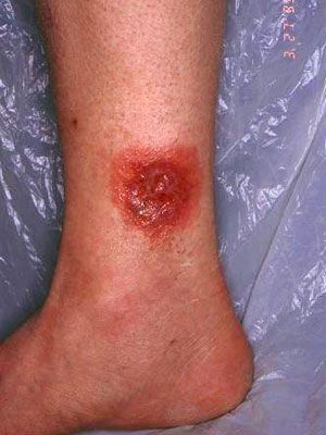 Name:  photogallery-spider-bites-06-full.jpg
Views: 119
Size:  26.4 KB