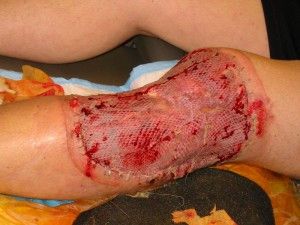 Name:  skin-graph-to-leg-bite-enlarged-300x225.jpg
Views: 90
Size:  18.0 KB