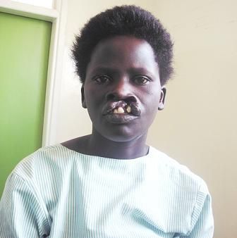 Cleft%20lip%20patient%20before%20operation.JPG