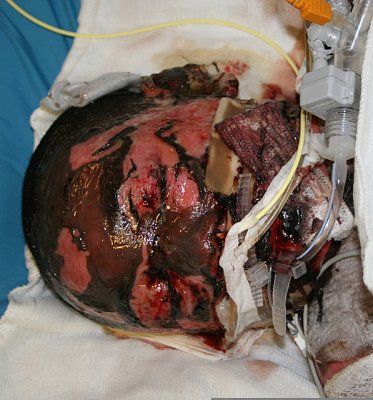 toxicepidermalnecrolysih.jpg