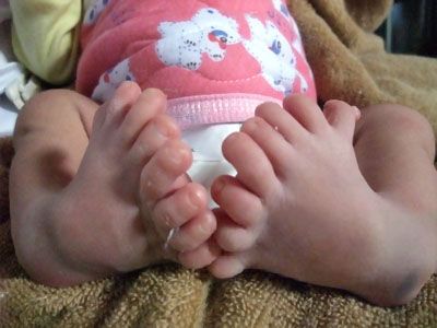 Name:  Baby-with-eight-toes.jpg
Views: 395
Size:  24.9 KB