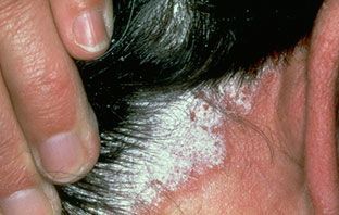 Name:  Plaque-Psoriasis%20%281%29.jpg
Views: 363
Size:  17.4 KB