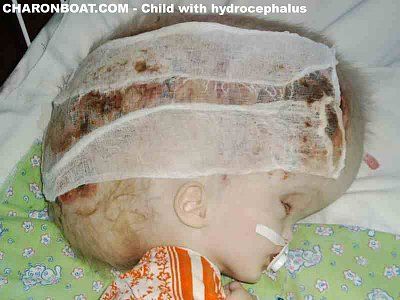 hydrocephaluschild3.jpg
