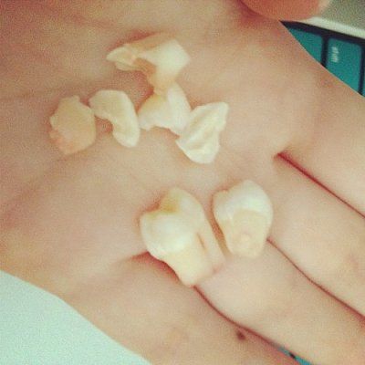 wisdom_teeth.jpg