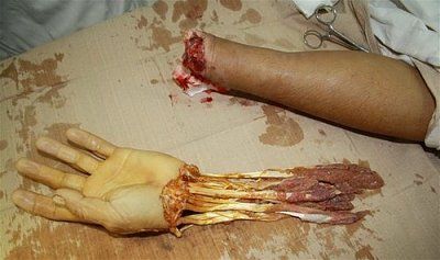 trauma-20hand-20apm.jpg