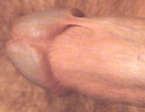 trauma_infant_circumcison_007.jpg