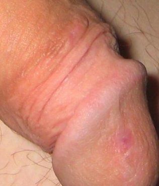 trauma_infant_circumcison_008.jpg