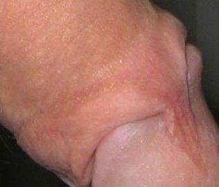 trauma_infant_circumcison_013.jpg