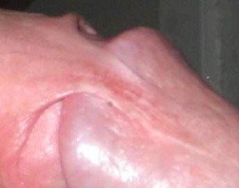 trauma_infant_circumcison_016.jpg