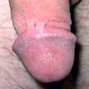 trauma_infant_circumcison_019.jpg