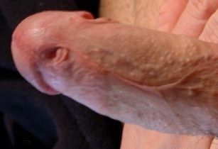 trauma_infant_circumcison_029.jpg
