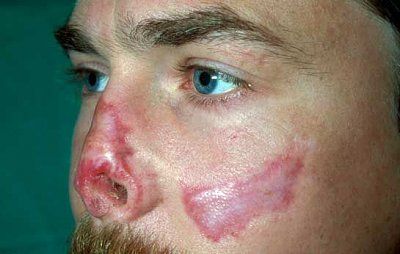 after-frostbite-has-gone....jpg