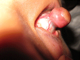 corneal-dermoid.gif