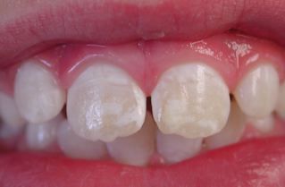 white-spots-on-teeth.jpg