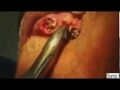Mans%20teeth%20removed%20to%20reveal%20gums%20infested%20with%20maggots.jpg
