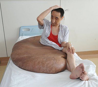 tumor242lbs.jpg