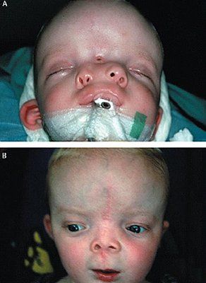 double-nose-removed-2.jpg