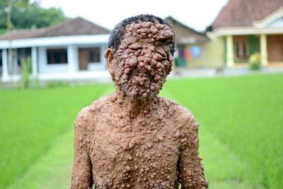 neurofibromatosis01.jpg