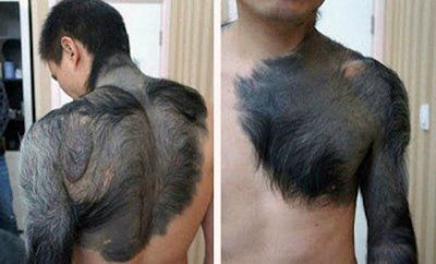 hypertrichosis-birthmark.jpg