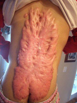 keloid_scar.jpg