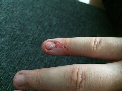 pulled-hangnail.jpg