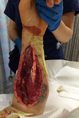infection-under-cast.jpg