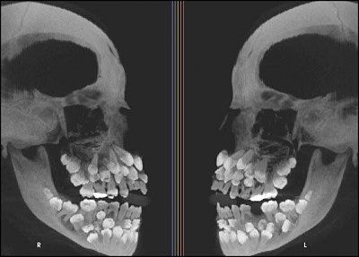multi-hyperdontia.jpg