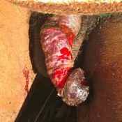 25%20%20Large%20wound.jpg