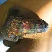 44%20%20Gangrene%20%28a%29.jpg