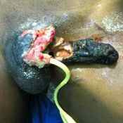 44%20%20Gangrene%20%28b%29.jpg