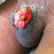 44%20%20Gangrene%20%28d%29.jpg