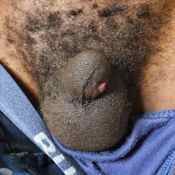 44%20%20Gangrene%20%28e%29.jpg