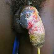 47%20%20Gangrene%20%28b%29.jpg