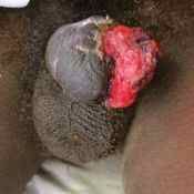 47%20%20Gangrene%20%28d%29.jpg